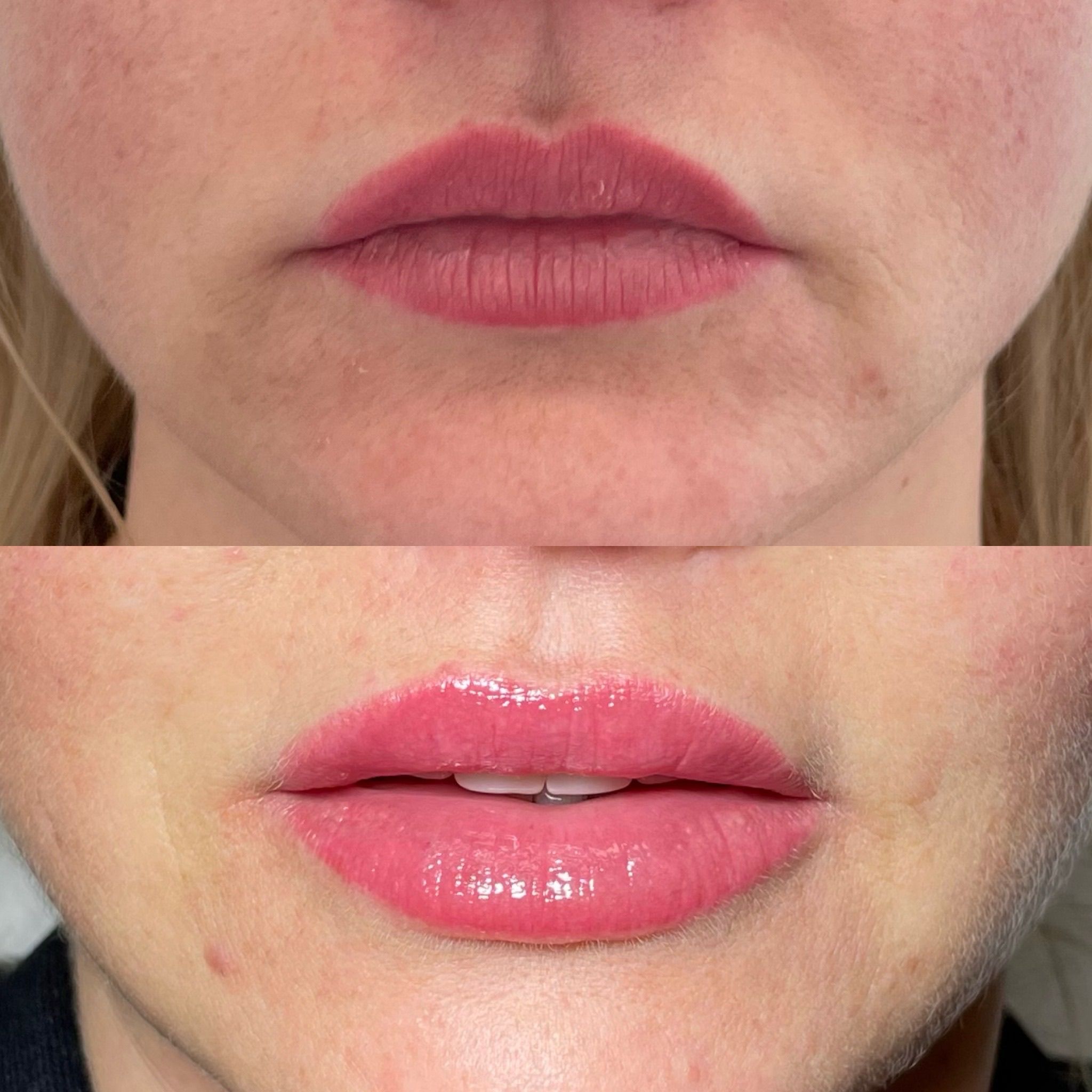 Lip Filler London: Refined Lip Augmentation for Natural, Balanced Results