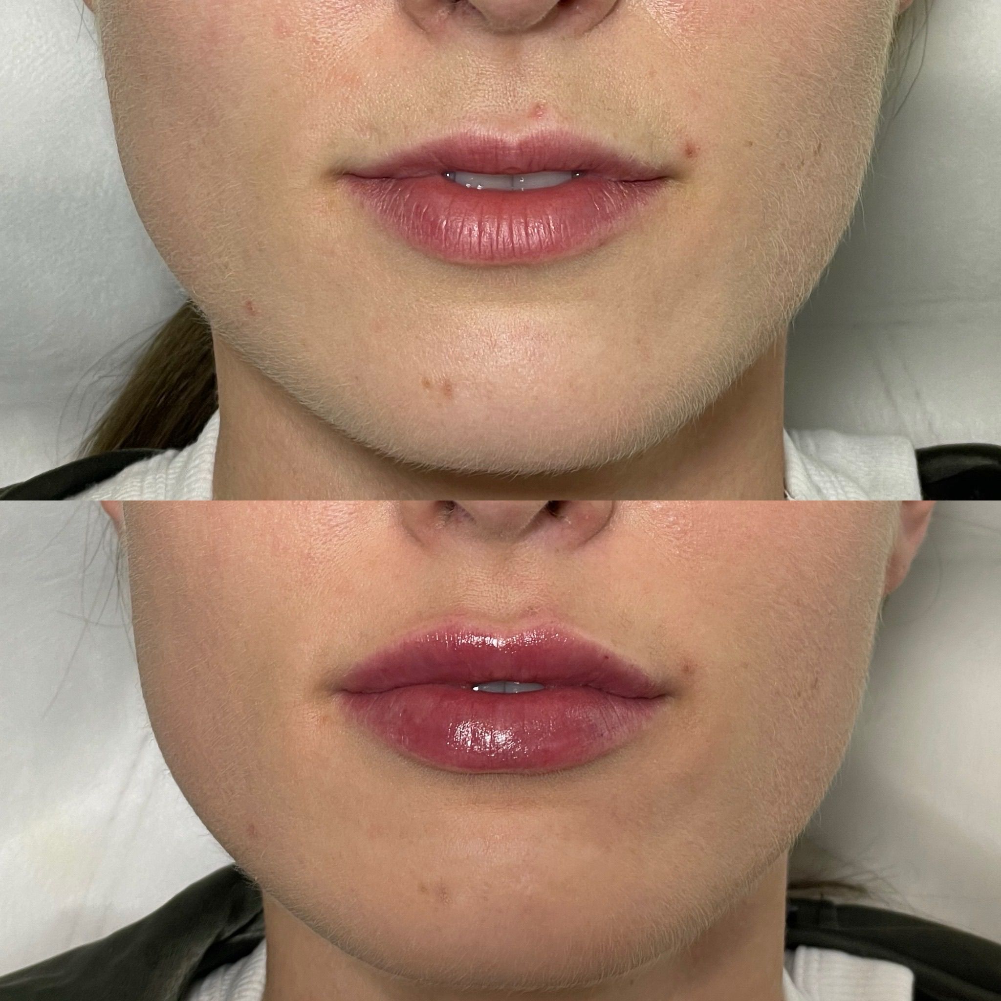 Lip Filler London: Refined Lip Augmentation for Natural, Balanced Results