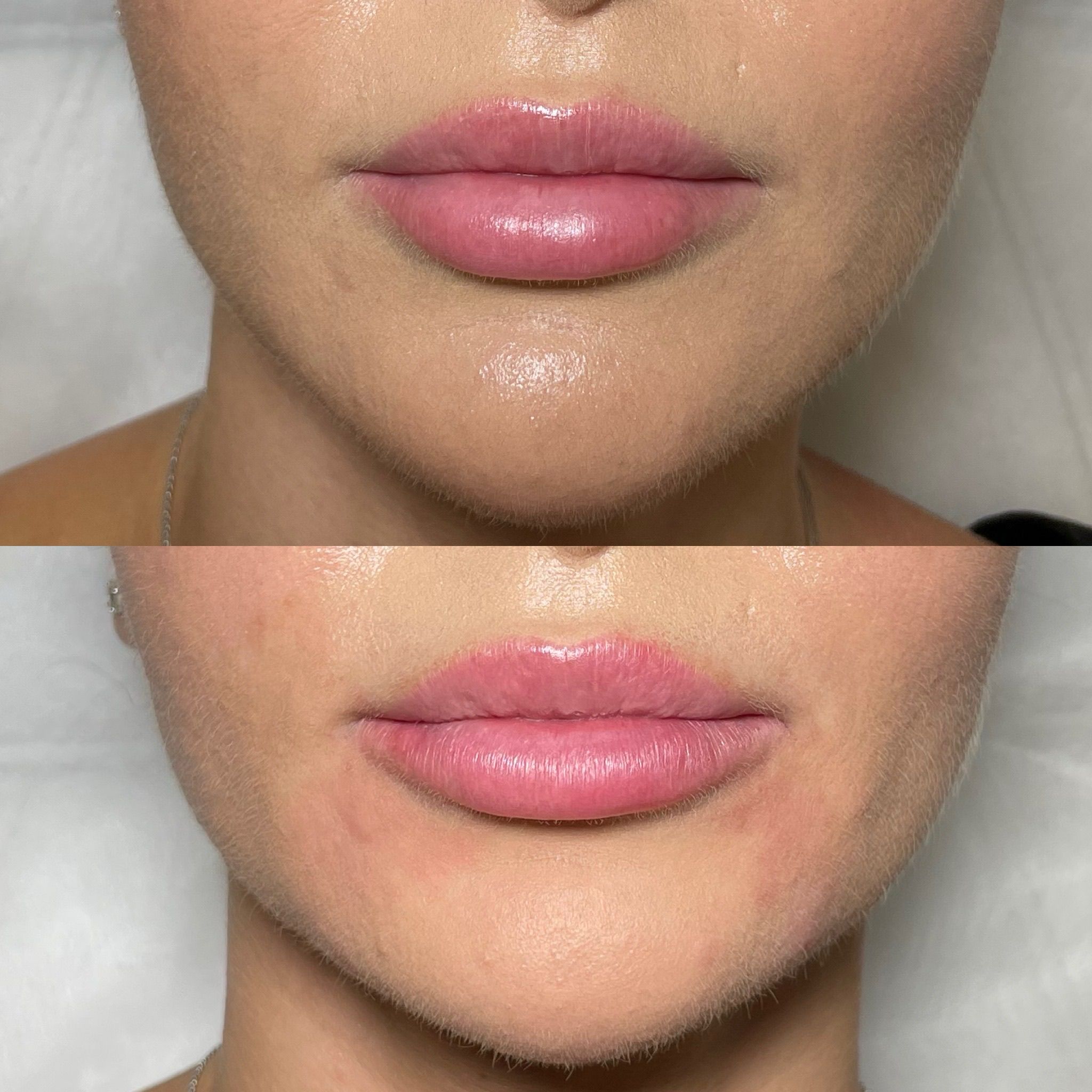 Lip Filler London: Refined Lip Augmentation for Natural, Balanced Results
